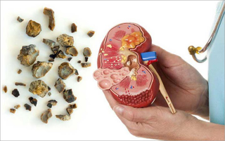 Illustration for article titled Nama Lain Dari Penyakit Kencing Batu